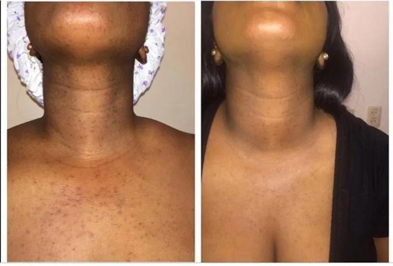 Avant et après sur le cou et le décolleté : taches nettement réduites.