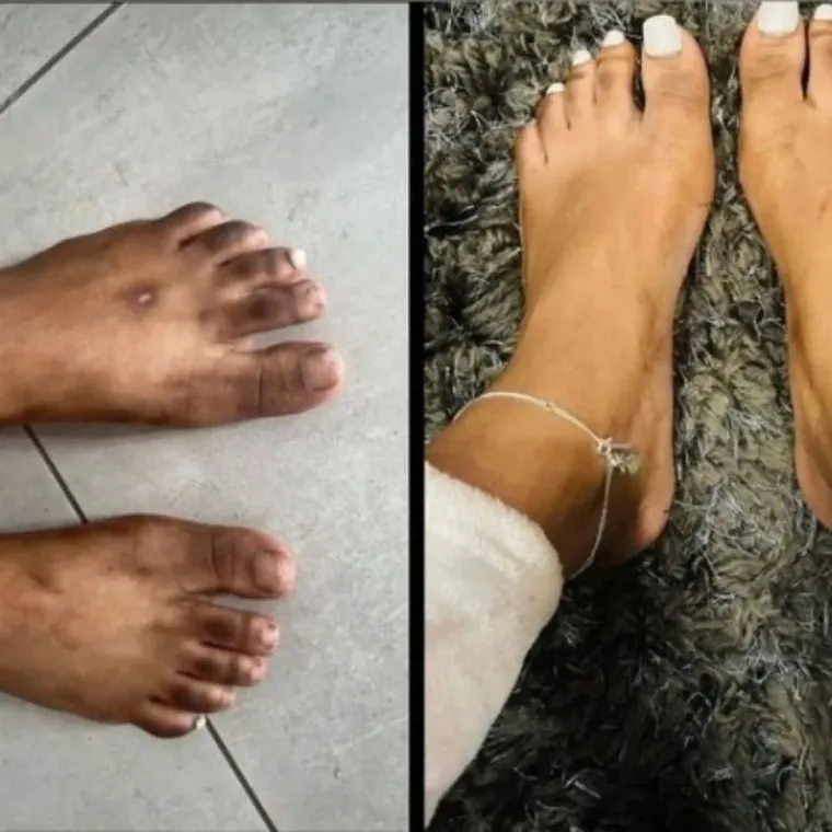 Avant et après sur les pieds : peau plus douce et plus claire.